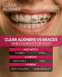 Braces vs Clear Aligners: Which Is Right for You?