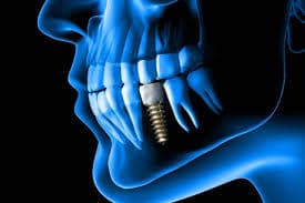 Dental Implants 101: What to Expect Before, During, and After