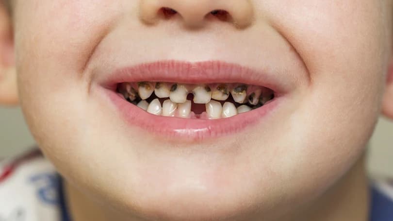 Kids and Cavities: A Parent's Guide to Prevention