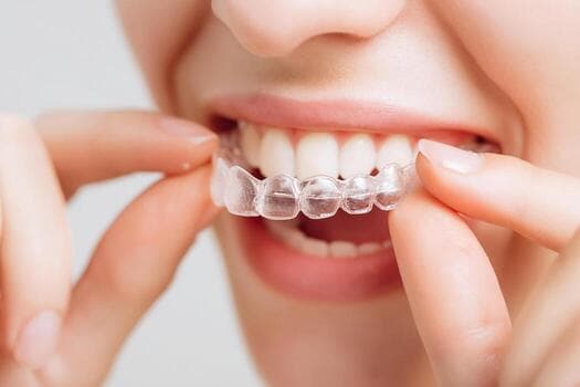 Clear Aligners