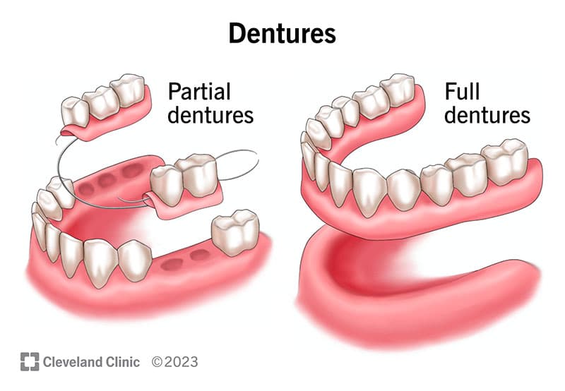 Complete & Partial Denture
