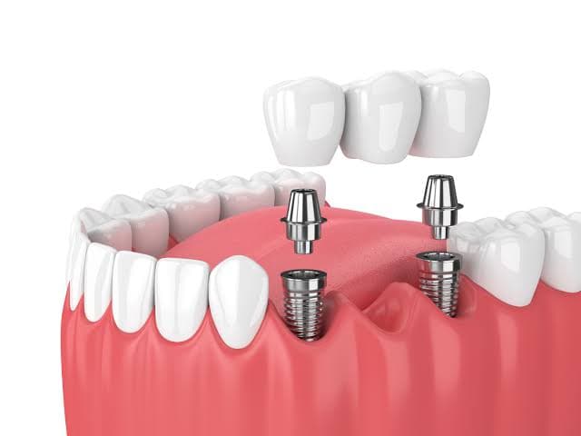 Dental Implant