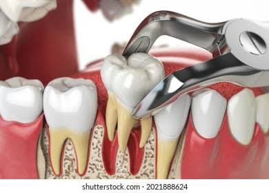 Extraction & Surgical Extraction