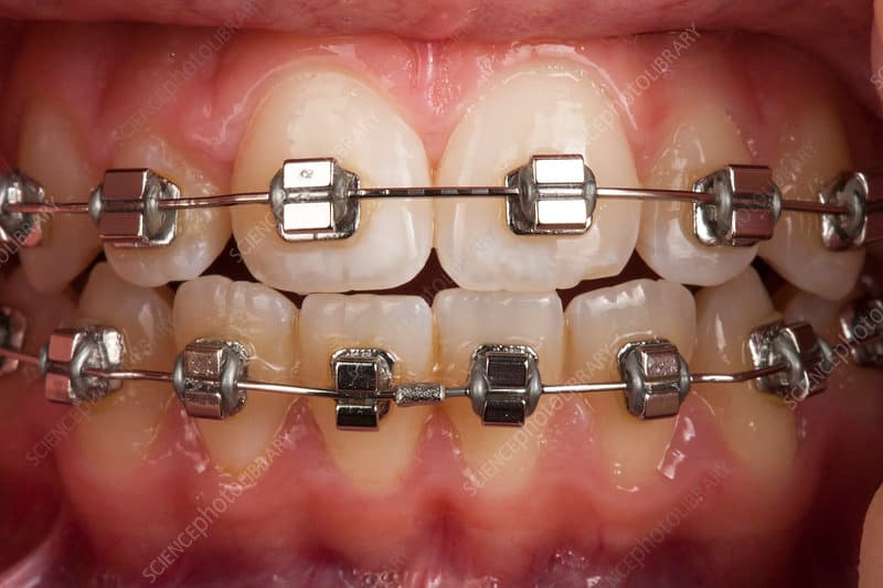 Fixed Orthodontic Treatment (Braces)