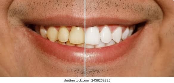 Tooth Whitening