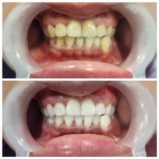 Scaling & Polishing