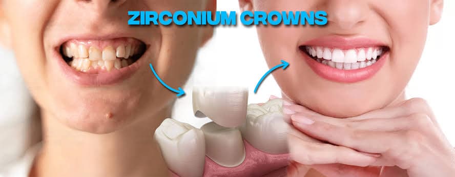 Crown & Bridge + Zirconia Crown
