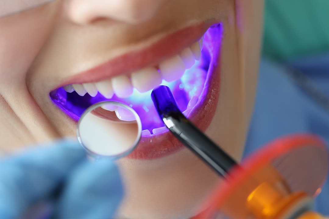 Light Cure Composite Filling